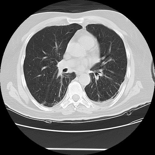 Cavitating pulmonary metastases (Radiopaedia 89545-106544 Axial lung window 30).jpg