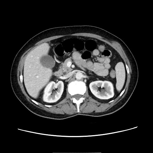 Cecal adenocarcinoma (Radiopaedia 75909-87331 A 34).jpg