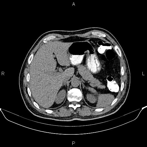 Cecal adenocarcinoma (Radiopaedia 85324-100916 Axial non-contrast 21).jpg