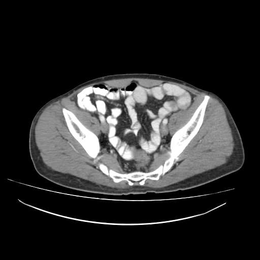 File:Cecal carcinoma with local lymphadenopathy (Radiopaedia 31428-32240 A 44).jpg