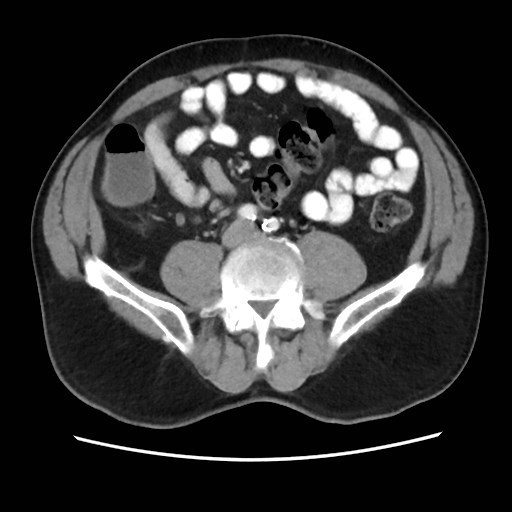 Cecal mass causing appendicitis (Radiopaedia 59207-66531 A 55).jpg