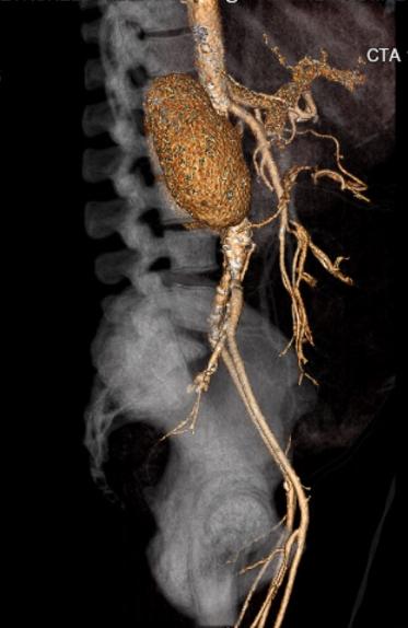File:Celiac artery severe stenosis and dissection (Radiopaedia 44128-47842 C+ arterial phase 8).jpg