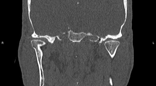 File:Central giant cell granuloma (Radiopaedia 83346-97761 Coronal bone window 29).jpg