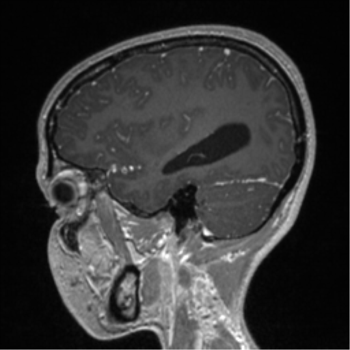 File:Central neurocytoma (Radiopaedia 37664-39557 Sagittal T1 C+ 27).png