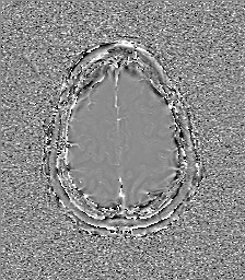 Central neurocytoma (Radiopaedia 84497-99872 Axial 61).jpg