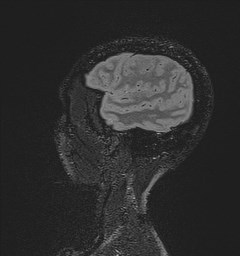 File:Central neurocytoma (Radiopaedia 84497-99872 Sagittal Flair + Gd 32).jpg