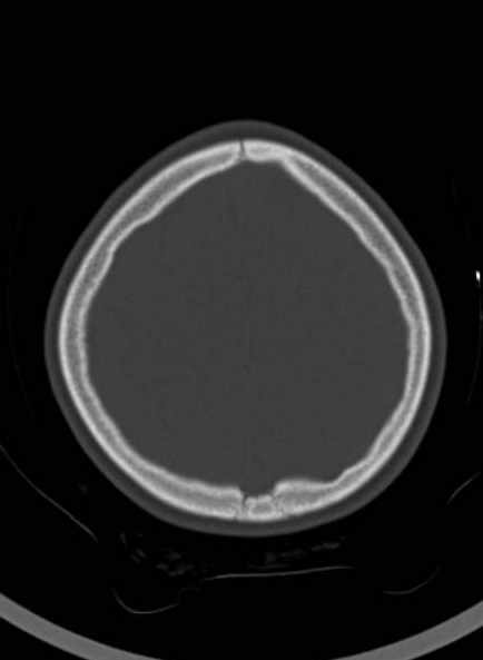 File:Cerebellar abscess (Radiopaedia 73727-84527 Axial bone window 55).jpg