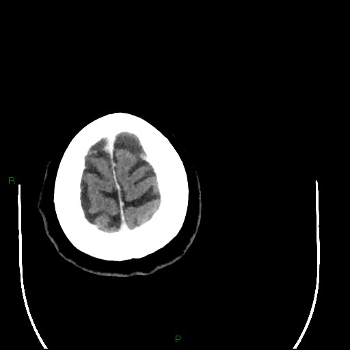 Cerebellar abscess (Radiopaedia 78135-90671 Axial C+ delayed 103).jpg