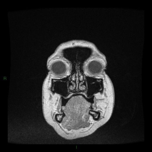 Cerebellar abscess (Radiopaedia 78135-90678 Coronal T1 C+ 6).jpg