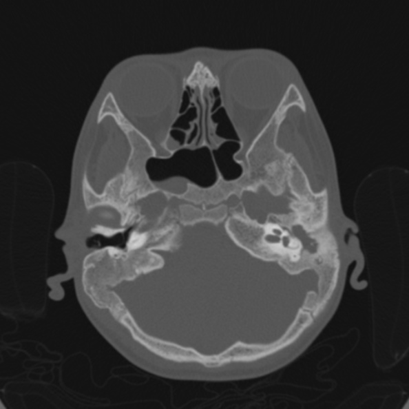 Cerebellar abscess secondary to mastoiditis (Radiopaedia 26284-26413 Axial bone window 48).jpg
