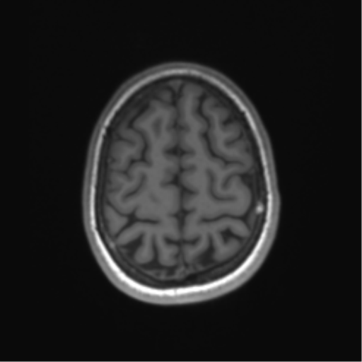 Cerebellar agenesis with hypoplastic pons (pontocerebellar hypoplasia) (Radiopaedia 57224-64138 Axial T1 64).png