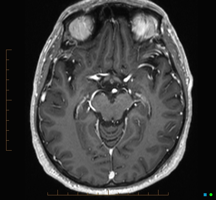 Cerebellar gangliocytoma (Radiopaedia 65377-74422 Axial T1 C+ 52).jpg