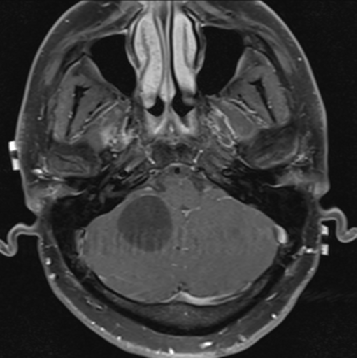File:Cerebellar hemangioblastomas and pituitary adenoma (Radiopaedia 85490-101176 Axial T1 C+ fat sat 9).png