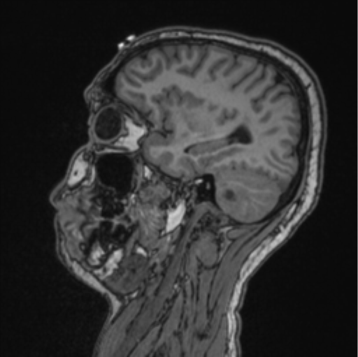 File:Cerebellar hemangioblastomas and pituitary adenoma (Radiopaedia 85490-101176 Sagittal T1 68).png