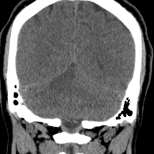 Cerebellar infarction (Radiopaedia 16625-16327 Coronal non-contrast 28).jpg