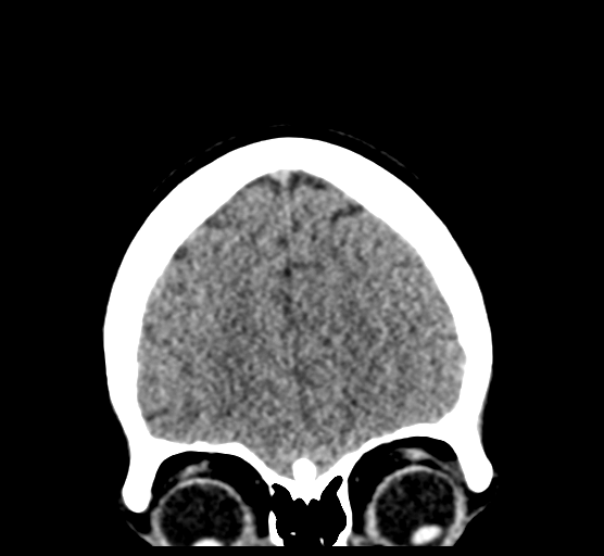 Cerebellar metastases - colorectal adenocarcinoma (Radiopaedia 40947-43652 Coronal non-contrast 22).png