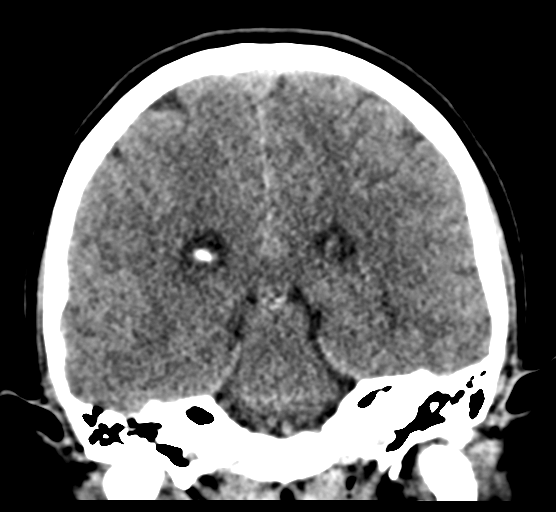 Cerebellar metastases - colorectal adenocarcinoma (Radiopaedia 40947-43652 Coronal non-contrast 58).png