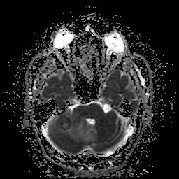 File:Cerebellar metastasis of pulmonary adenocarcinoma, cavernous venous malformation, and developmental venous anomaly (Radiopaedia 85827-101661 Axial ADC 10).jpg