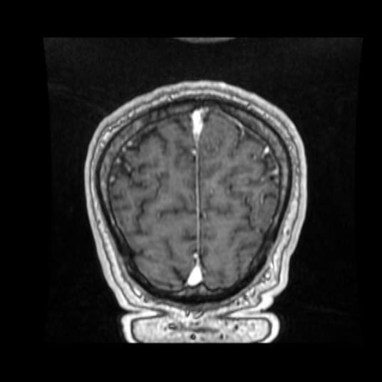 Cerebellar metastasis of pulmonary adenocarcinoma, cavernous venous malformation, and developmental venous anomaly (Radiopaedia 85827-101661 Coronal T1 C+ 22).jpg