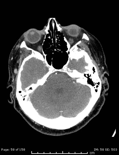 Cerebellar strokes due to intracranial giant cell arteritis (Radiopaedia 68799-78510 CT angiogram 58).jpg