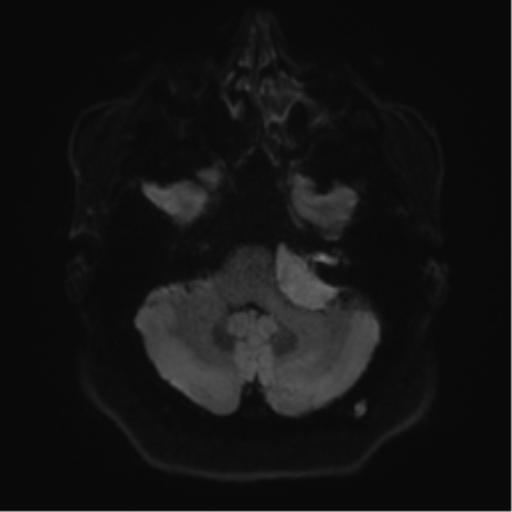 Cerebellopontine angle meningioma (Radiopaedia 48434-53348 Axial DWI 44).png