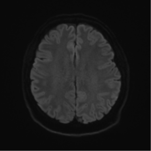 Cerebellopontine angle meningioma (Radiopaedia 48434-53348 Axial DWI 62).png