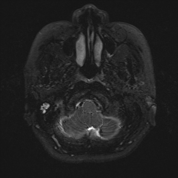 Cerebellopontine angle meningioma (Radiopaedia 53561-59591 Axial 3D volume T2 12).jpg