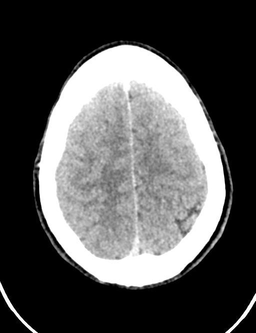 Cerebral abscess (Radiopaedia 60342-68008 Axial non-contrast 43).png