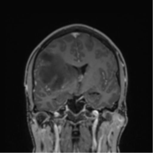 Cerebral abscess (Radiopaedia 60342-68009 H 27).png