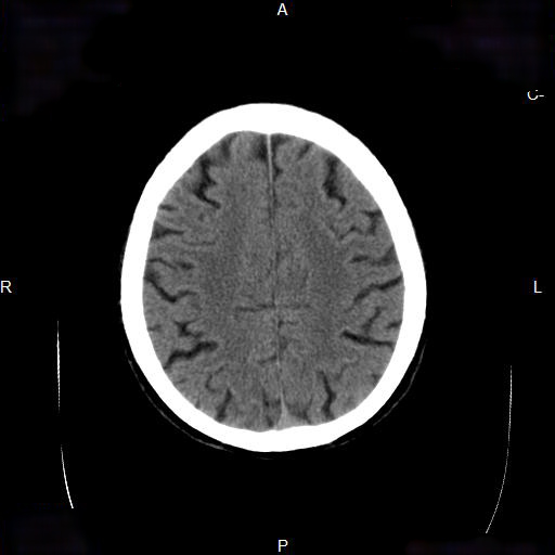 File:Cerebral abscess (Radiopaedia 7606-8431 Axial non-contrast 20).jpg