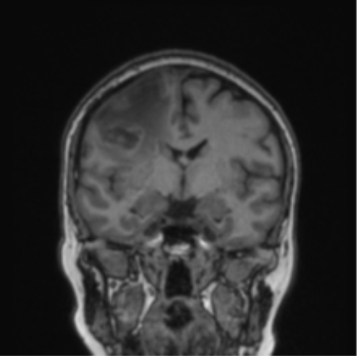 File:Cerebral abscess from pulmonary arteriovenous malformation (Radiopaedia 86275-102291 Coronal T1 51).png