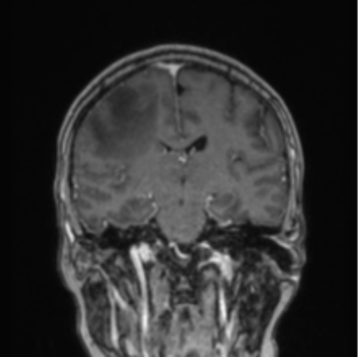 File:Cerebral abscess from pulmonary arteriovenous malformation (Radiopaedia 86275-102291 L 44).png