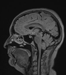 Cerebral abscess from pulmonary arteriovenous malformation (Radiopaedia 86275-102291 Sagittal FLAIR 36).png