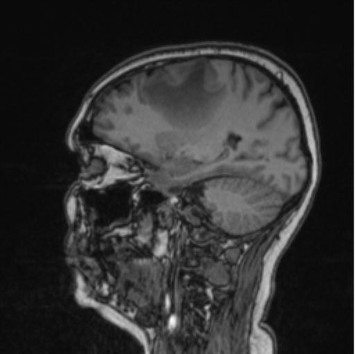 Cerebral abscess from pulmonary arteriovenous malformation (Radiopaedia 86275-102291 Sagittal T1 63).png