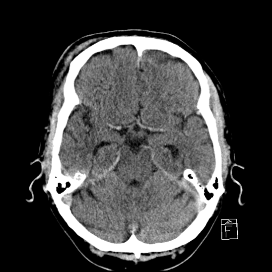 File:Cerebral abscess with ventriculitis (Radiopaedia 78965-91877 A 17).jpg