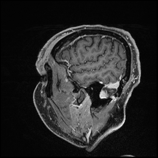 Cerebral abscess with ventriculitis (Radiopaedia 78965-91878 Sagittal T1 C+ 34).jpg