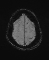 Cerebral amyloid angiopathy-related inflammation (Radiopaedia 74836-85849 Axial SWI 61).jpg