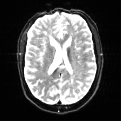 Cerebral amyloid angiopathy (Radiopaedia 46082-50433 Axial DWI 16).png