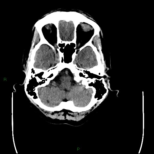 File:Cerebral amyloid angiopathy (Radiopaedia 77506-89665 Axial non-contrast 21).jpg