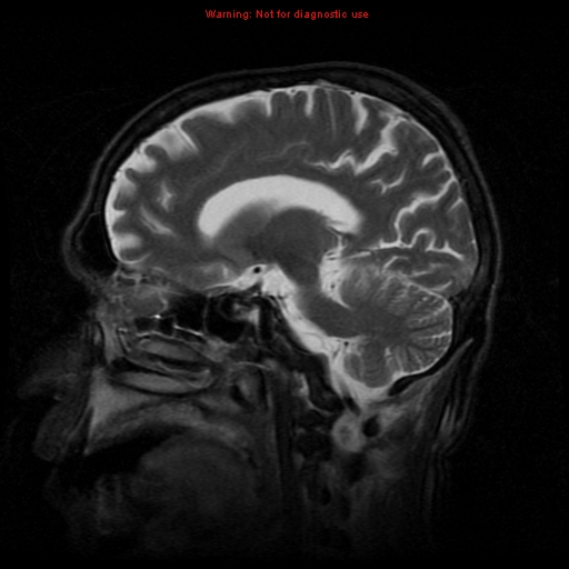 File:Cerebral and orbital tuberculomas (Radiopaedia 13308-13311 Sagittal T2 8).jpg