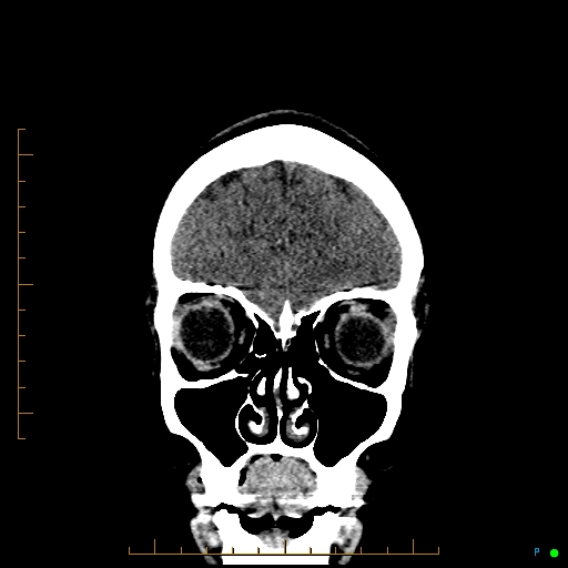 Cerebral arteriovenous malformation (AVM) (Radiopaedia 78162-90706 Coronal non-contrast 19).jpg