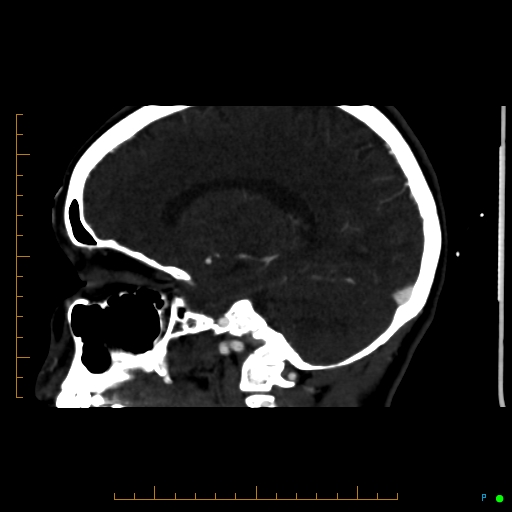 Cerebral arteriovenous malformation (AVM) (Radiopaedia 78162-90706 Sagittal CTA 50).jpg