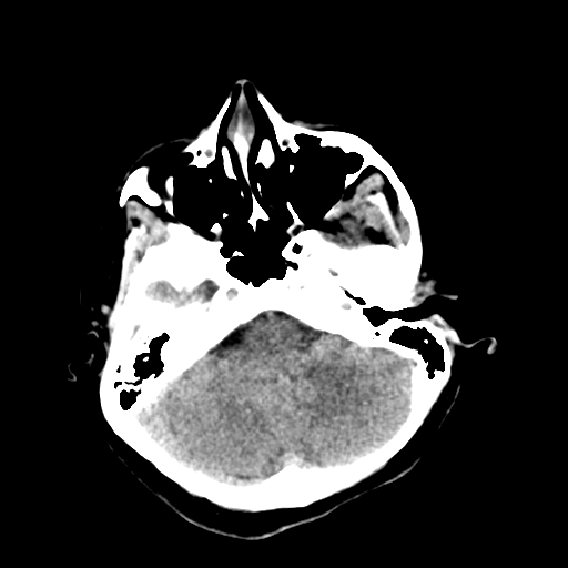 File:Cerebral arteriovenous malformation (Radiopaedia 73830-84645 Axial non-contrast 10).jpg