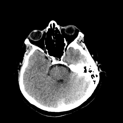 File:Cerebral arteriovenous malformation (Radiopaedia 73830-84645 Axial non-contrast 14).jpg