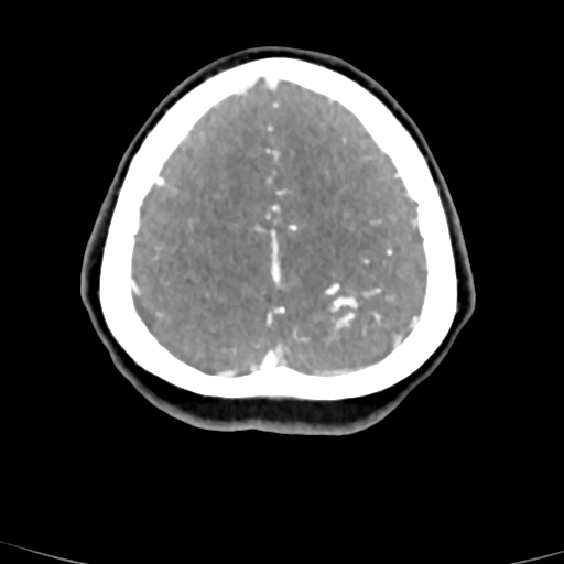 Cerebral arteriovenous malformation (Radiopaedia 73830-84645 B 18).jpg