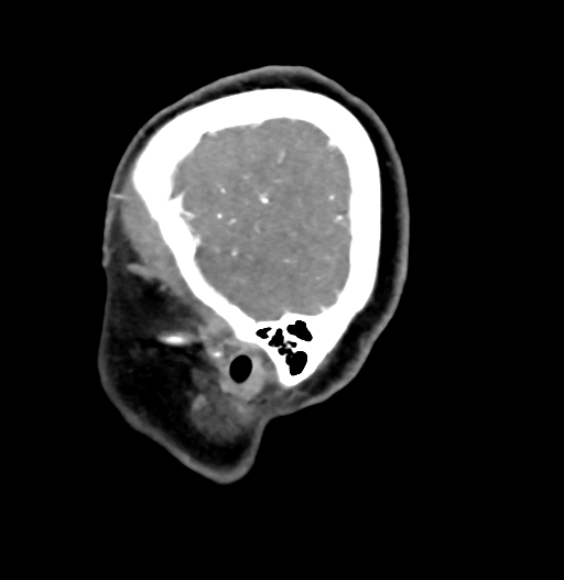 Cerebral arteriovenous malformation (Radiopaedia 73830-84645 D 10).jpg