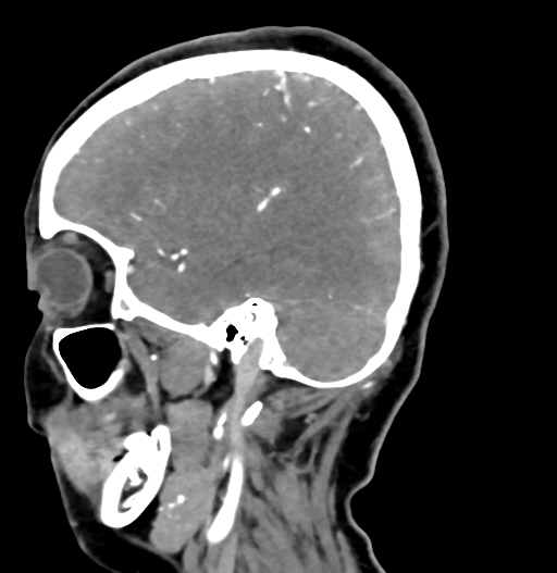 Cerebral arteriovenous malformation (Radiopaedia 73830-84645 D 68).jpg
