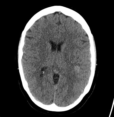 File:Cerebral arteriovenous malformation (Radiopaedia 74411-85744 Axial non-contrast 18).jpg