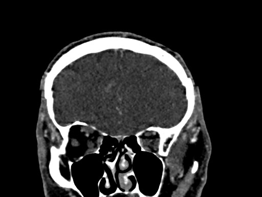 Cerebral arteriovenous malformation (Radiopaedia 78188-90746 Coronal C+ delayed 23).jpg