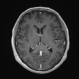 Cerebral arteriovenous malformation (Radiopaedia 84015-99245 Axial T1 C+ 84).jpg